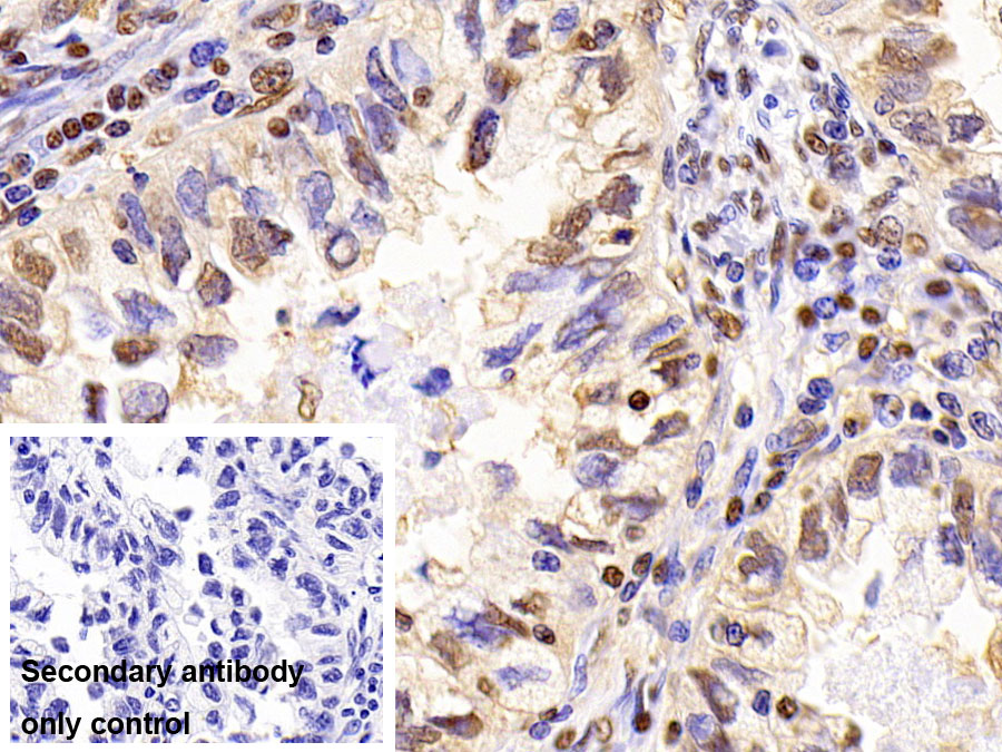 DAB staining on IHC-P; Sample: Human Lymphoma Tissue; Primary Ab: 20ug/ml Mouse Anti-Human GAPDH Antibody; Control: Used PBS instead of primary antibody; Second Ab: 2ug/ml HRP-Linked Caprine Anti-Mouse IgG Polyclonal Antibody