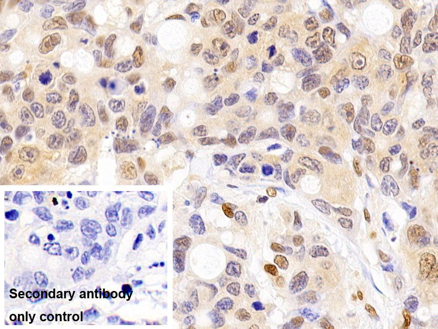DAB staining on IHC-P; Sample: Human liver Cirrhosis Tissue; Primary Ab: 20ug/ml Mouse Anti-Human GAPDH Antibody; Control: Used PBS instead of primary antibody; Second Ab: 2ug/ml HRP-Linked Caprine Anti-Mouse IgG Polyclonal Antibody