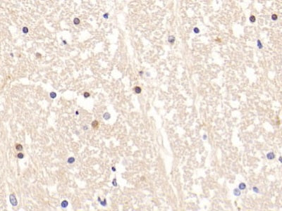 DAB staining on IHC-P; Sample: Human Breast cancer Tissue; Primary Ab: 10ug/ml Rabbit Anti-Multi-species ACTH Antibody; Second Ab: 2ug/mL HRP-Linked Caprine Anti-Rabbit IgG Polyclonal Antibody