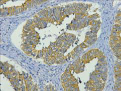 IHC staining of human colon cancer tissue, diluted at 1:200.