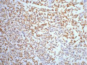 IHC staining of Human small cell carcinoma of lung tissue, diluted at 1:200.