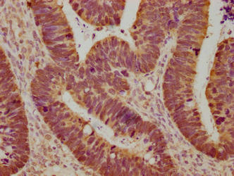 Immunohistochemical of paraffin-embedded human ovarian cancer using CSB-MA0128871A0m at dilution of 1:100