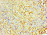 Immunohistochemical of paraffin-embedded human cervical cancer using CSB-MA0206411A0m at dilution of 1:200