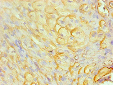 Immunohistochemical of paraffin-embedded human cervical cancer using CSB-MA0206411A0m at dilution of 1:200