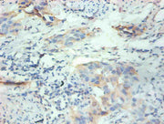 Immunohistochemical of paraffin-embedded human breast cancer tissue using CSB-MA077601A0m at dilution of 1:200