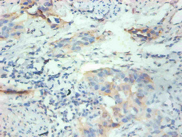 Immunohistochemical of paraffin-embedded human breast cancer tissue using CSB-MA077601A0m at dilution of 1:200