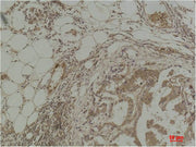 Immunohistochemical analysis of paraffin-embedded Human Breast Carcinoma using Pan Methylated Lysine Monoclonal Antibody.