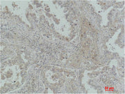 Immunohistochemical analysis of paraffin-embedded Human Lung Carcinoma using MICU1 Monoclonal Antibody.