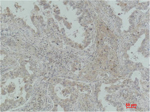 Immunohistochemical analysis of paraffin-embedded Human Lung Carcinoma using MICU1 Monoclonal Antibody.