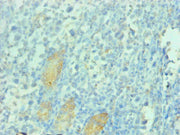 Immunohistochemical of paraffin-embedded human gastric cancer tissue using CSB-MA112991A0m at dilution of 1:200