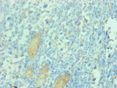 Immunohistochemical of paraffin-embedded human gastric cancer tissue using CSB-MA112991A0m at dilution of 1:200