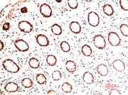 Immunohistochemical analysis of paraffin-embedded Human Colon Carcinoma Tissue using Collagen I Mouse mAb diluted at 1:200.