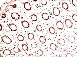 Immunohistochemical analysis of paraffin-embedded Human Colon Carcinoma Tissue using Collagen I Mouse mAb diluted at 1:200.