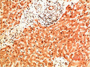 Immunohistochemical analysis of paraffin-embedded Human Liver Carcinoma Tissue using Collagen IV Mouse mAb diluted at 1:200.