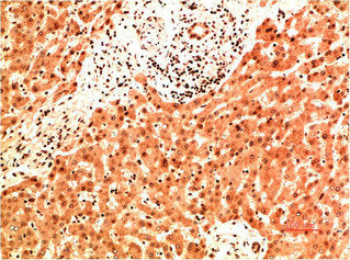 Immunohistochemical analysis of paraffin-embedded Human Liver Carcinoma Tissue using Collagen IV Mouse mAb diluted at 1:200.