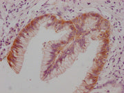 IHC image of CSB-MA148581 diluted at 1:100 and staining in paraffin-embedded human pancreatic cancer performed on a Leica BondTM system. After dewaxing and hydration, antigen retrieval was mediated by high pressure in a citrate buffer (pH 6.0). Se...