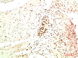 Immunohistochemical analysis of paraffin-embedded Human Colon Carcinoma Tissue using HP-1 α Mouse mAb diluted at 1:200.