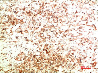 Immunohistochemical analysis of paraffin-embedded Human Ovarian Carcinoma Tissue using ATG5 Mouse mAb diluted at 1:200.