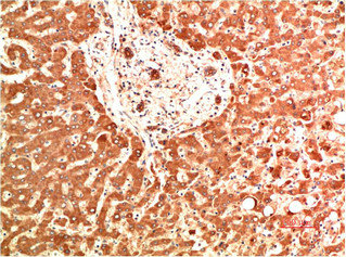 Immunohistochemical analysis of paraffin-embedded Human Liver Carcinoma Tissue using Collagen IV Mouse mAb diluted at 1:200.