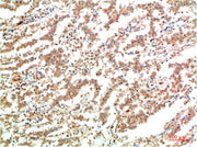 Immunohistochemical analysis of paraffin-embedded Human Lung Carcinoma Tissue using JAK2 Mouse mAb diluted at 1:200.