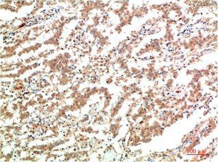 Immunohistochemical analysis of paraffin-embedded Human Lung Carcinoma Tissue using JAK2 Mouse mAb diluted at 1:200.