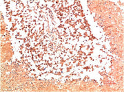 Immunohistochemical analysis of paraffin-embedded Human Lung Carcinoma Tissue using Collagen II Mouse mAb diluted at 1:200.