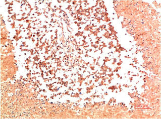 Immunohistochemical analysis of paraffin-embedded Human Lung Carcinoma Tissue using Collagen II Mouse mAb diluted at 1:200.