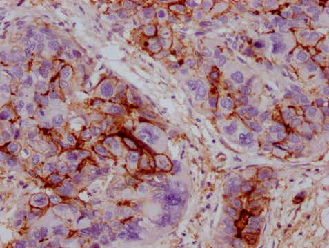 IHC image of CSB-MA211660 diluted at 1:100 and staining in paraffin-embedded human liver cancer performed on a Leica BondTM system. After dewaxing and hydration, antigen retrieval was mediated by high pressure in a citrate buffer (pH 6.0). Section...