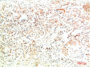 Immunohistochemical analysis of paraffin-embedded Human Lung Carcinoma Tissue using Collagen II Mouse mAb diluted at 1:200.