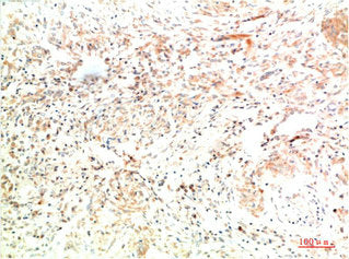 Immunohistochemical analysis of paraffin-embedded Human Lung Carcinoma Tissue using Collagen II Mouse mAb diluted at 1:200.