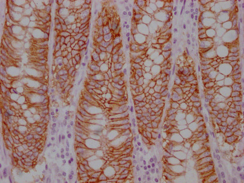 IHC image of CSB-MA221818 diluted at 1:100 and staining in paraffin-embedded human colon cancer performed on a Leica BondTM system. After dewaxing and hydration, antigen retrieval was mediated by high pressure in a citrate buffer (pH 6.0). Section...
