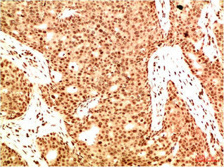 Immunohistochemical analysis of paraffin-embedded Human Breast Carcinoma Tissue using Acetyl NF kB P65(K314/K315) Mouse mAb diluted at 1:200.