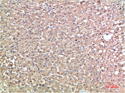 Immunohistochemical analysis of paraffin-embedded Human Liver Carcinoma Tissue using TTR Mouse mAb diluted at 1:200.