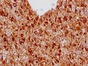 IHC image of CSB-MA293354 diluted at 1:100 and staining in paraffin-embedded human glioma cancer performed on a Leica BondTM system. After dewaxing and hydration, antigen retrieval was mediated by high pressure in a citrate buffer (pH 6.0). Sectio...