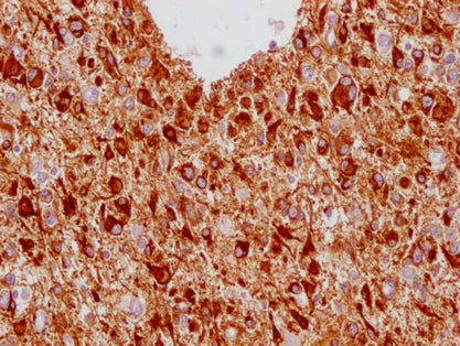 IHC image of CSB-MA293354 diluted at 1:100 and staining in paraffin-embedded human glioma cancer performed on a Leica BondTM system. After dewaxing and hydration, antigen retrieval was mediated by high pressure in a citrate buffer (pH 6.0). Sectio...