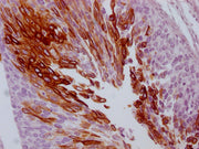 IHC image of CSB-MA299720 diluted at 1:100 and staining in paraffin-embedded human cervical cancer performed on a Leica BondTM system. After dewaxing and hydration, antigen retrieval was mediated by high pressure in a citrate buffer (pH 6.0). Sect...