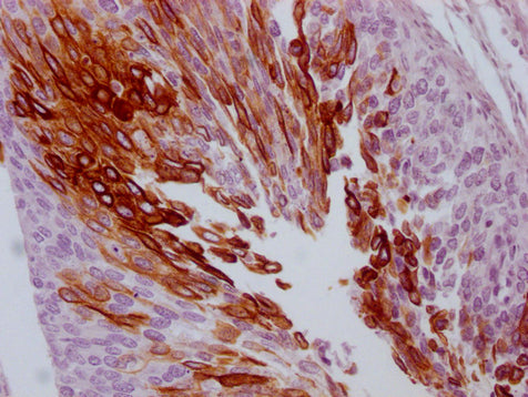 IHC image of CSB-MA299720 diluted at 1:100 and staining in paraffin-embedded human cervical cancer performed on a Leica BondTM system. After dewaxing and hydration, antigen retrieval was mediated by high pressure in a citrate buffer (pH 6.0). Sect...