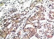 Immunohistochemical analysis of paraffin-embedded Human Breast Carcinoma Tissue using Ubiquitin Mouse mAb diluted at 1:200.