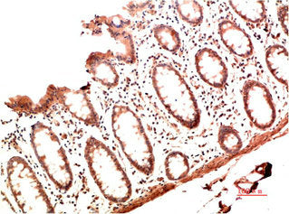 Immunohistochemical analysis of paraffin-embedded Human Colon Carcinoma Tissue using Collagen I Mouse mAb diluted at 1:200.