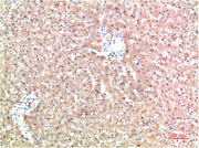 Immunohistochemical analysis of paraffin-embedded Human Liver Carcinoma Tissue using TTR Mouse mAb diluted at 1:200.