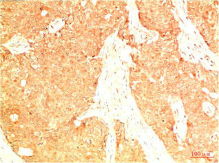 Immunohistochemical analysis of paraffin-embedded Human Breast Carcinoma Tissue using Acetyl P53(K382) Mouse mAb diluted at 1:200.
