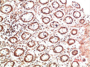 Immunohistochemical analysis of paraffin-embedded Human Colon Carcinoma Tissue using Collagen II Mouse mAb diluted at 1:500