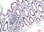 Immunohistochemical analysis of paraffin-embedded Human Colon Carcinoma Tissue using HP-1γ Mouse mAb diluted at 1:200.