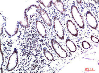 Immunohistochemical analysis of paraffin-embedded Human Colon Carcinoma Tissue using HP-1γ Mouse mAb diluted at 1:200.