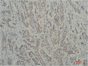 Immunohistochemical analysis of paraffin-embedded Human Breast Carcinoma using TBP/TATA Binding Protein（mAb diluted at 1:200.