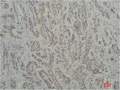 Immunohistochemical analysis of paraffin-embedded Human Breast Carcinoma using TBP/TATA Binding Protein（mAb diluted at 1:200.