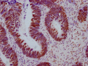 IHC image of CSB-MA442659 diluted at 1:100 and staining in paraffin-embedded human ovarian cancer performed on a Leica BondTM system. After dewaxing and hydration, antigen retrieval was mediated by high pressure in a citrate buffer (pH 6.0). Secti...