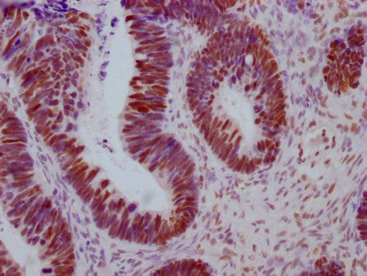 IHC image of CSB-MA442659 diluted at 1:100 and staining in paraffin-embedded human ovarian cancer performed on a Leica BondTM system. After dewaxing and hydration, antigen retrieval was mediated by high pressure in a citrate buffer (pH 6.0). Secti...