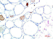 Immunohistochemical analysis of paraffin-embedded Human Liver Carcinoma Tissue using TTR Mouse mAb diluted at 1:200.