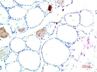 Immunohistochemical analysis of paraffin-embedded Human Liver Carcinoma Tissue using TTR Mouse mAb diluted at 1:200.
